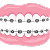 Clear Braces Aligners